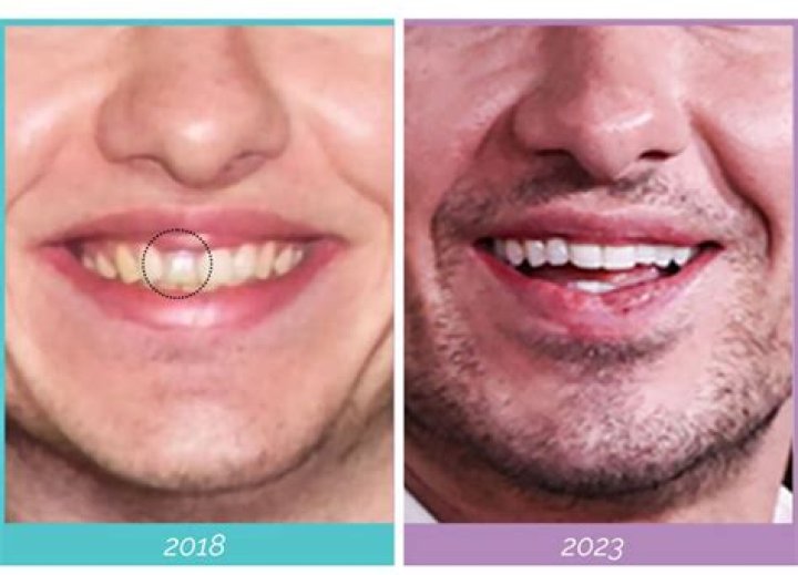 Barry Keoghan's Plastic Surgery: A Detailed Guide