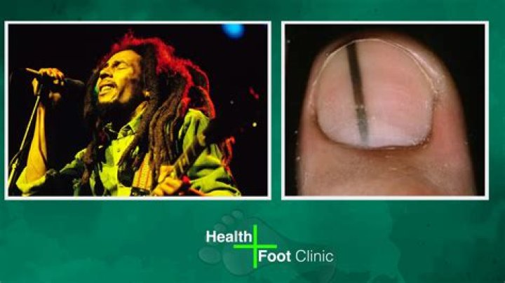 Bob Marley's Cause Of Death And The Toe Connection