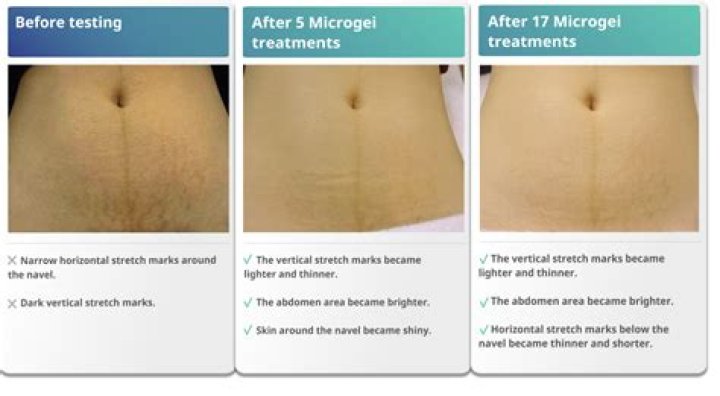 Do hot baths help stretch marks? ·