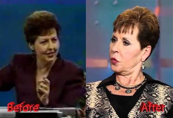 Joyce Meyers' Plastic Surgery Journey: Before And After Transformation