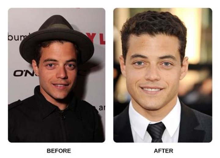 Unveiling Matt Rife's Dental Surgery Journey: Secrets Revealed