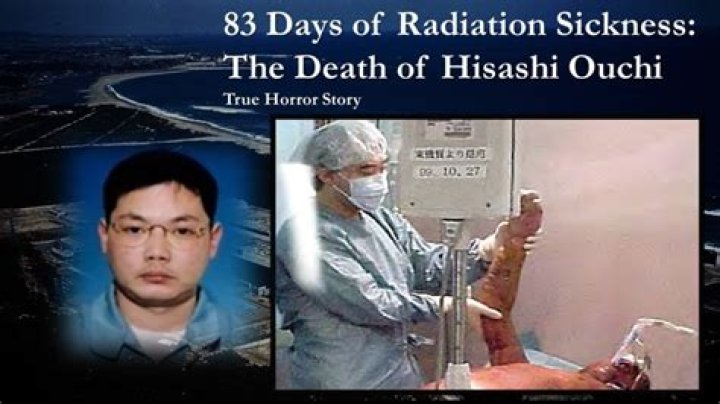 The Devastating Aftermath Of Hisashi Ouchi's Radiation Exposure