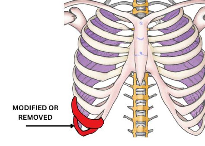 The Ultimate Guide To Before And After Rib Removal