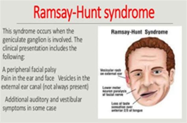 The Ultimate Guide To Ramsay Hunt Syndrome: Causes, Symptoms, And Treatment